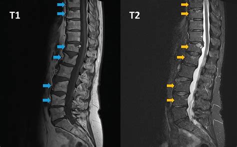 Vertebral Fractures After Denosumab Cessation Cleveland Clinic