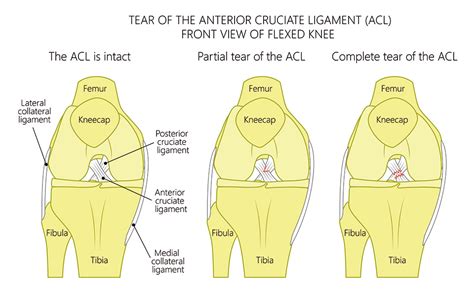 Ligamento Cruzado Anterior Parte Funci N Y Abordaje Kin Tica