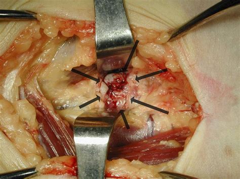 Endobutton Repair Of Distal Biceps Tendon Ruptures Journal Of Hand