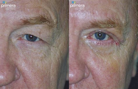 Blepharoplasty Before And After Pictures Case 120 Orlando And Tampa