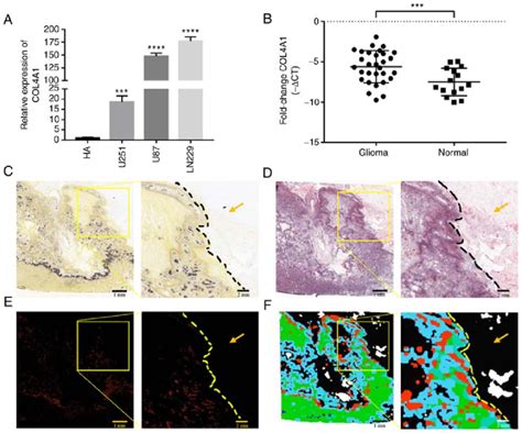 Expression Levels Of Col A In Glioma Are Abnormally Increased A The