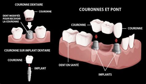 Couronne Dentaire Trois Rivi Res Clinique Dentaire Asselin