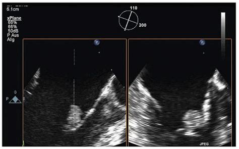 Left-Sided Hemiparesis | Thoracic Key