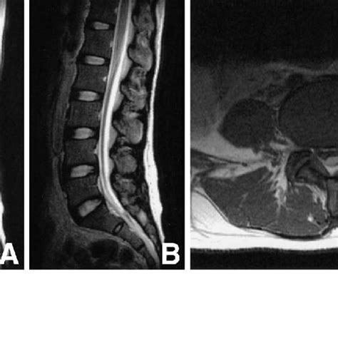 Case 3 Lumbar Spinal Magnetic Resonance Images Showing Late