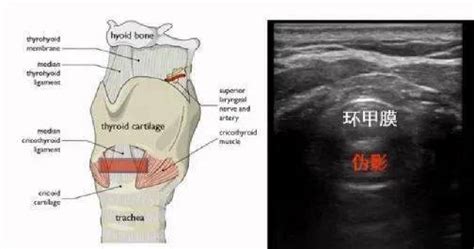 实用！超声引导下的经皮气管切开技术颈部