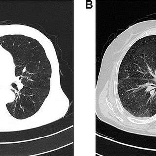 PDF Sex Differences Of COPD Phenotypes In Nonsmoking Patients