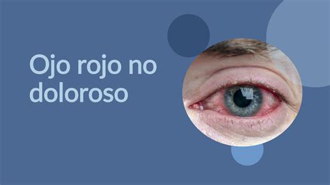 Solution Presentacion Ojo Rojo No Doloroso Conjuntivitis Hemorragia