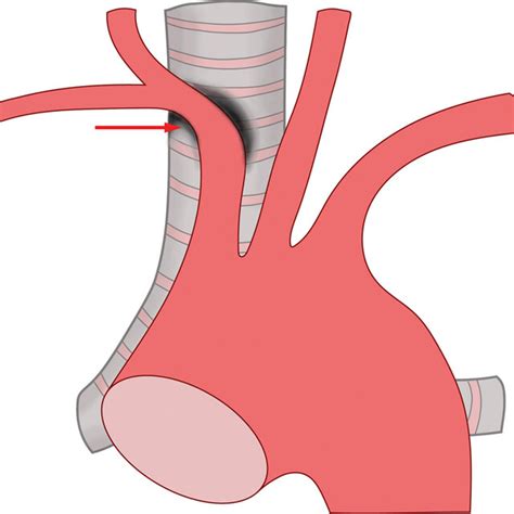 Embryology Of The Superior Vena Cava And Brachiocephalic Vein The Main Download Scientific