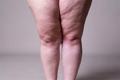 Cirurgia de lipedema saiba quando ela é necessária