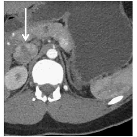 Preoperative Axial Ct Scan With Iv Contrast Arterial Phase Of Procedure