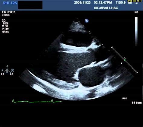 Echocardiography Parasternal Long Axis Youtube