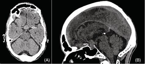 CT Scan Of The Brain A Axial View B Sagittal View Showing An