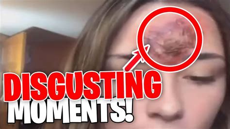 The MOST DISGUSTING Dr Pimple Popper Moments That Made Us SHUDDER