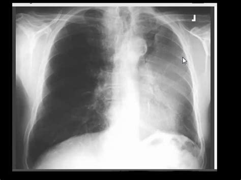 Lung Collapse Chest X Ray