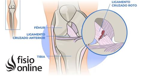 Esguince De Rodilla Qué Es Síntomas Clasificacion Causas Y Tratamiento