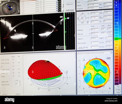 CORNEAL TOPOGRAPHY Stock Photo - Alamy