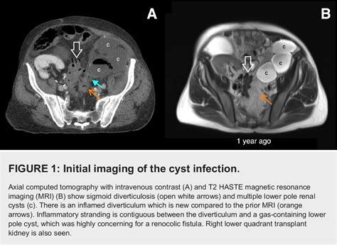 [pdf] Rupture Of An Infected Renal Cyst Secondary To A Renocolic