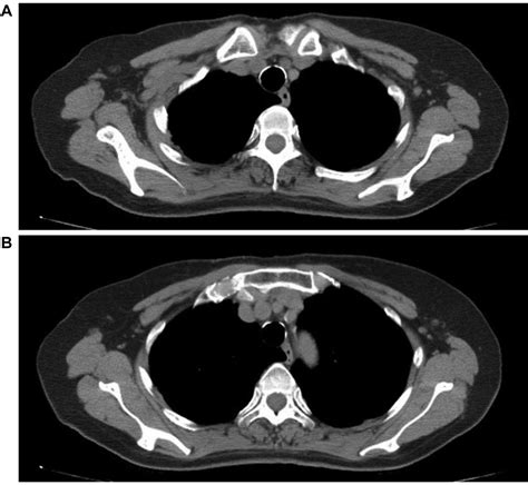 Axillary Lymph Node Swelling Mimicking Breast Cancer Metastasis After