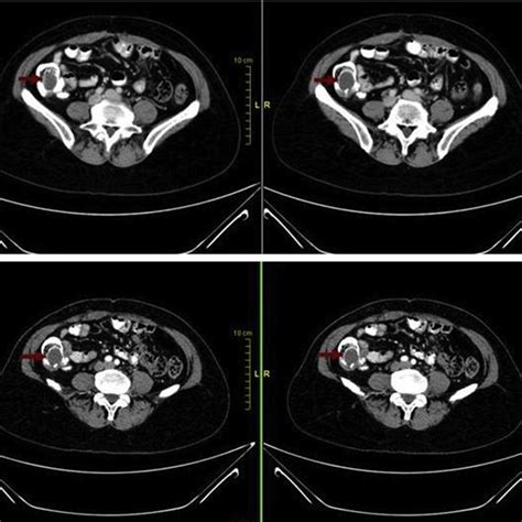 Normal appearance of the appendix on CT. The normal appendix ( arrow ...