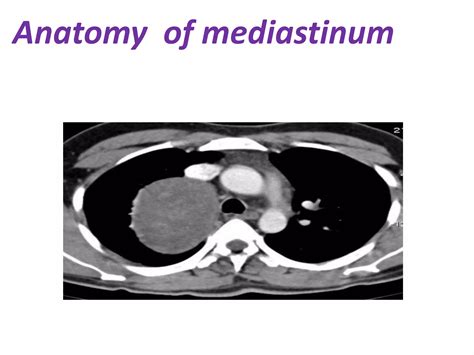 Mediastinal anatomy ,classification of mediastinal masses ans its ...
