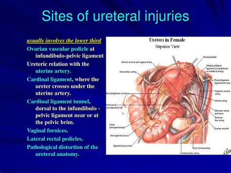 Ppt Endoscopic Management Of Iatrogenic Ureteric Strictures Powerpoint Presentation Id 1288437