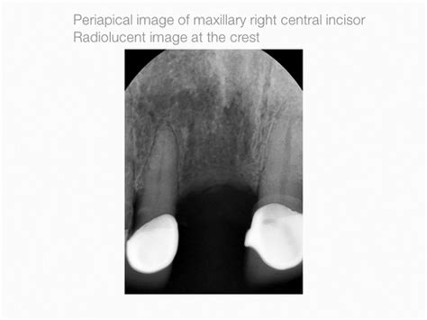 Vertical Augmentation Ti Oss