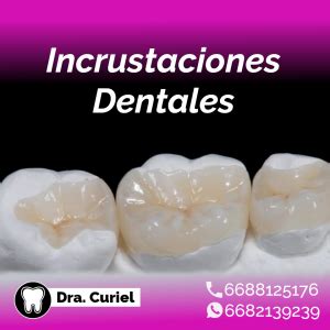 Incrustaciones Dentales Doctora Curiel