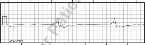 ECG showing the agonal heart rhythm. | Download Scientific Diagram