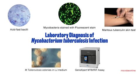 Laboratory Diagnosis Of Mycobacterium Tuberculosis Infection • Microbe Online