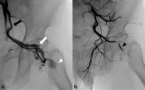 Avf Due To A Fall In A 43 Year Old Man A Selective Angiography Of The Download Scientific