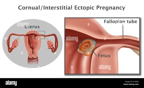 Interstitial Ectopic Pregnancy Hi Res Stock Photography And Images Alamy