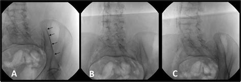 Obturator Inlet And Iliac Oblique Technique For Safe Convenient And