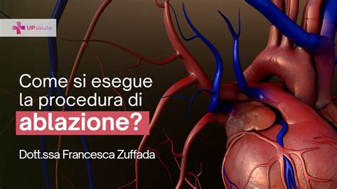 Come Si Esegue La Procedura Di Ablazione Dott Ssa Francesca Zuffada