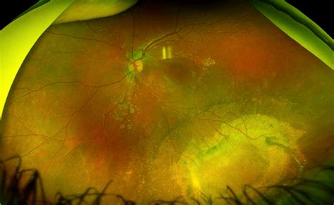 Mystery Diagnosis: X-Linked Retinoschisis — Matt Weed, MD Spokane ...