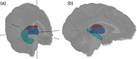 High Resolution Diffusion Tensor Imaging Of The Fornix Predicts Memory