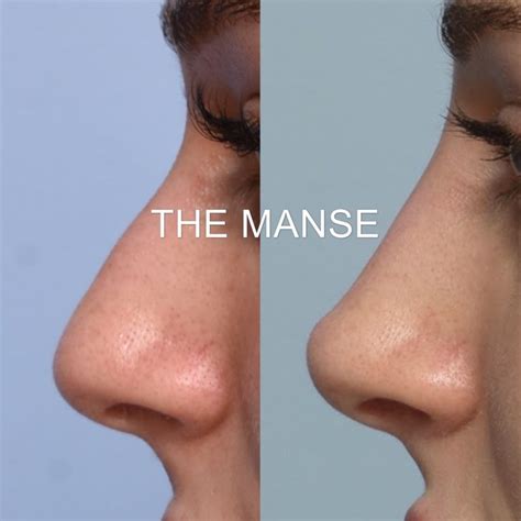 Nose Filler Best Clinic Sydney For Dermal Fillers