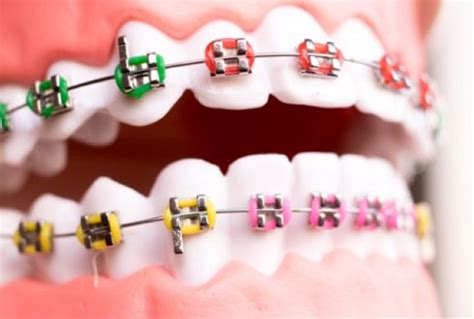 Choosing The Best Braces Colors