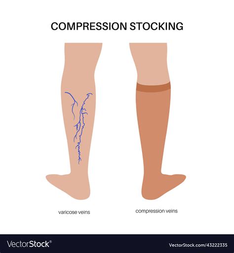 Compression stocking pressure Royalty Free Vector Image