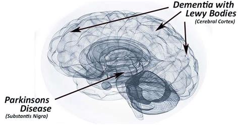 Lewy Body Dementia And Parkinsons 2 Diseases Similar Cause