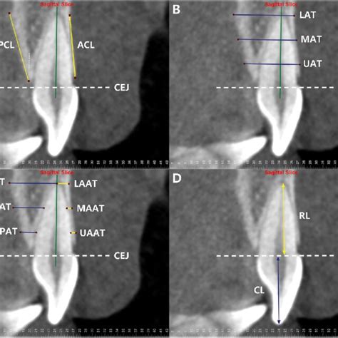 Comparison Of The Anterior And Posterior Alveolar Bone Thickness Of