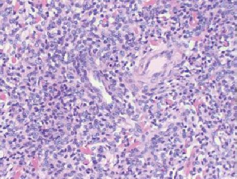 Endometrial stromal sarcoma: round cells and small vessels (HE stain ...