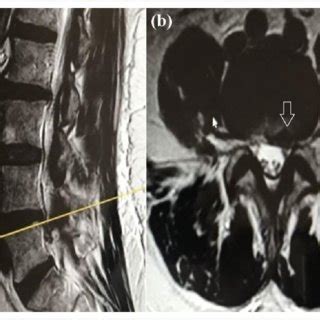 A Sagittal And B Axial Preoperative T Weighted Mri Of A Patient In