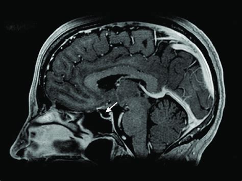 Magnetic Resonance Imaging Brain Scan Showing Empty Sella Arrow Download Scientific Diagram