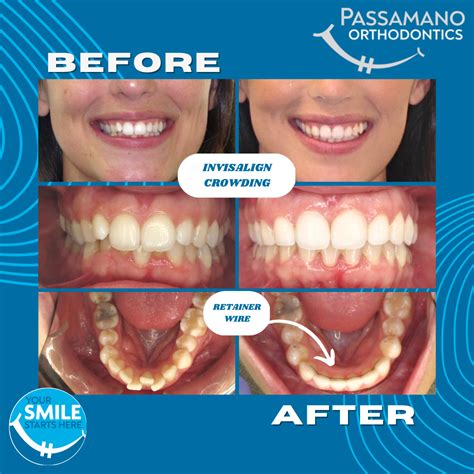 Before And After Invisalign Overbite