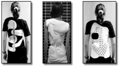 Scoliosis Brace Types Boston Spinecor And Adult Back Braces