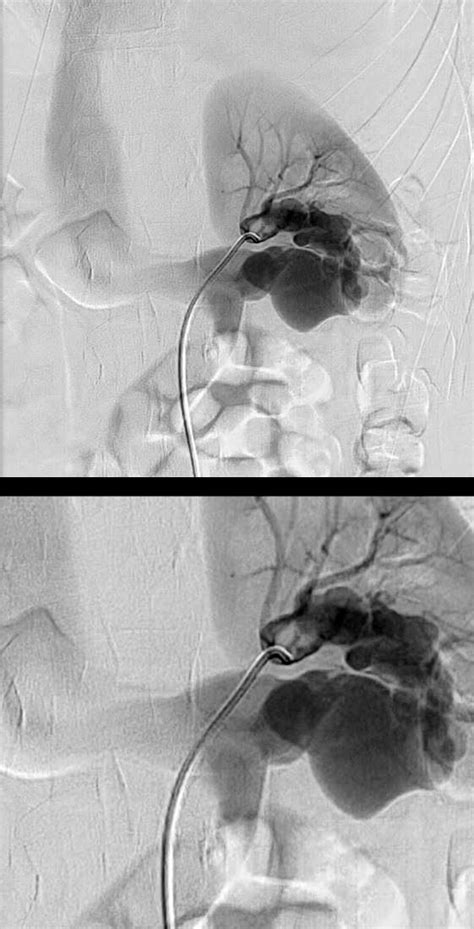 IF Finding Arteriovenous Fistula (AVF) | Kidney