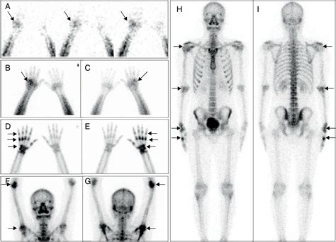 99mtc Mdp Three Phase Bone Scan For Early Diagnosis And Treatment