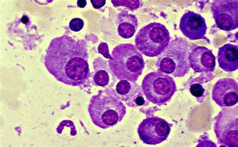 Multiple Myeloma Stages Life Expectancy