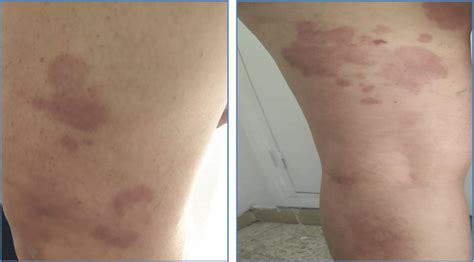 Case 2 Erythematous And Pruritic Herpetiform Rash On The Limbs One