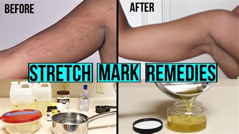 How To Get Rid Of Stretch Marks And Scars Diy At Home Stretch Mark